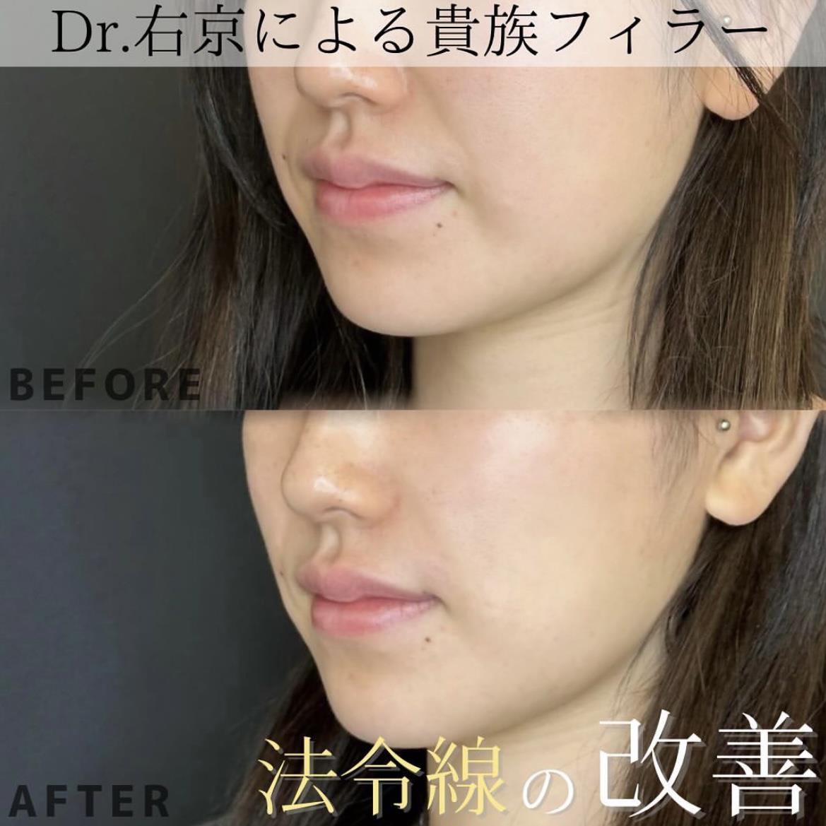 ヒアルロン酸の症例写真