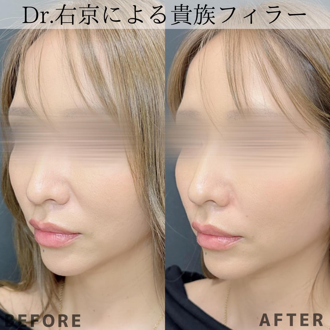 ヒアルロン酸の症例写真