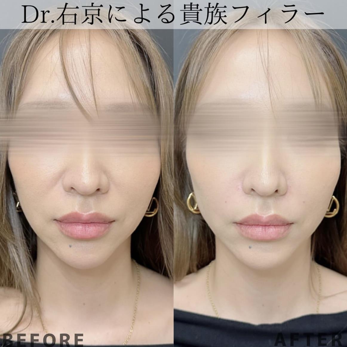 ヒアルロン酸の症例写真