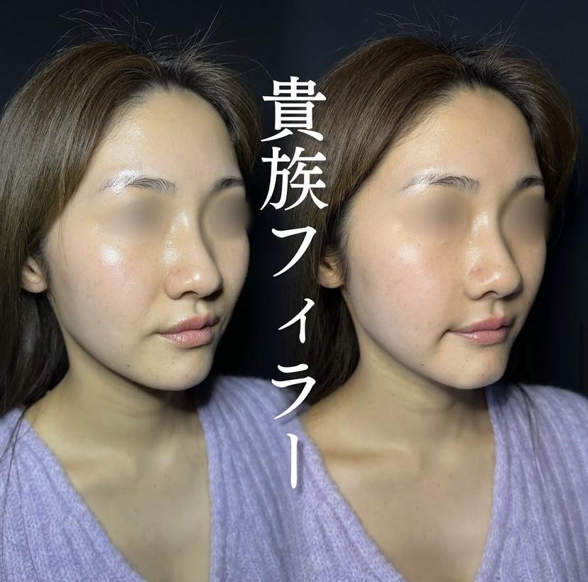 ヒアルロン酸の症例写真