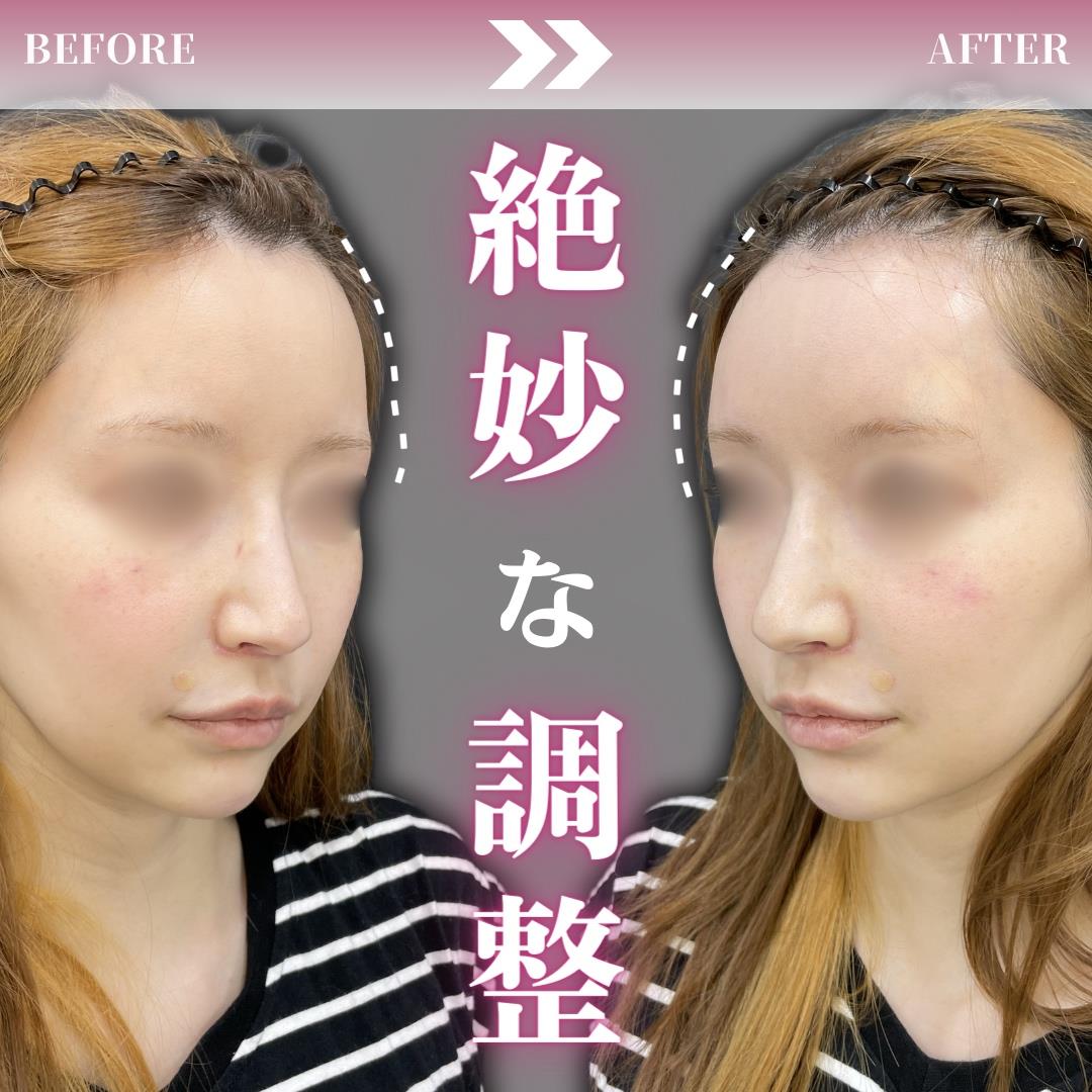 ヒアルロン酸の症例写真