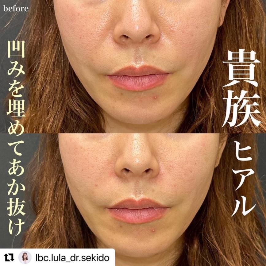 ヒアルロン酸の症例写真