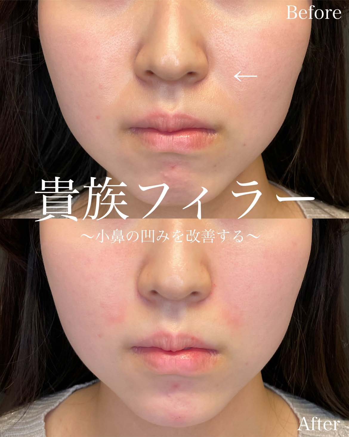 ヒアルロン酸の症例写真