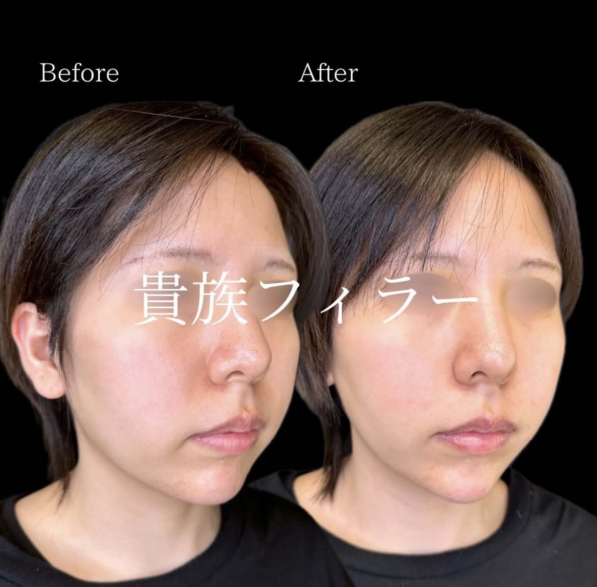 ヒアルロン酸の症例写真