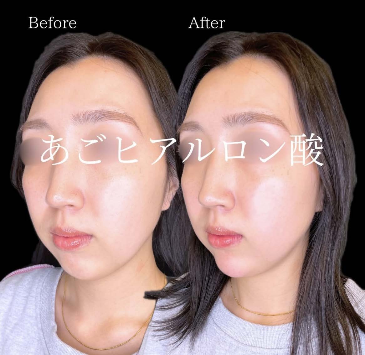 ヒアルロン酸の症例写真