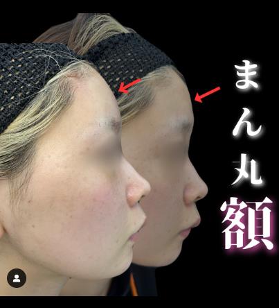 ヒアルロン酸の症例写真