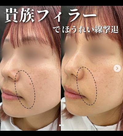 ヒアルロン酸の症例写真