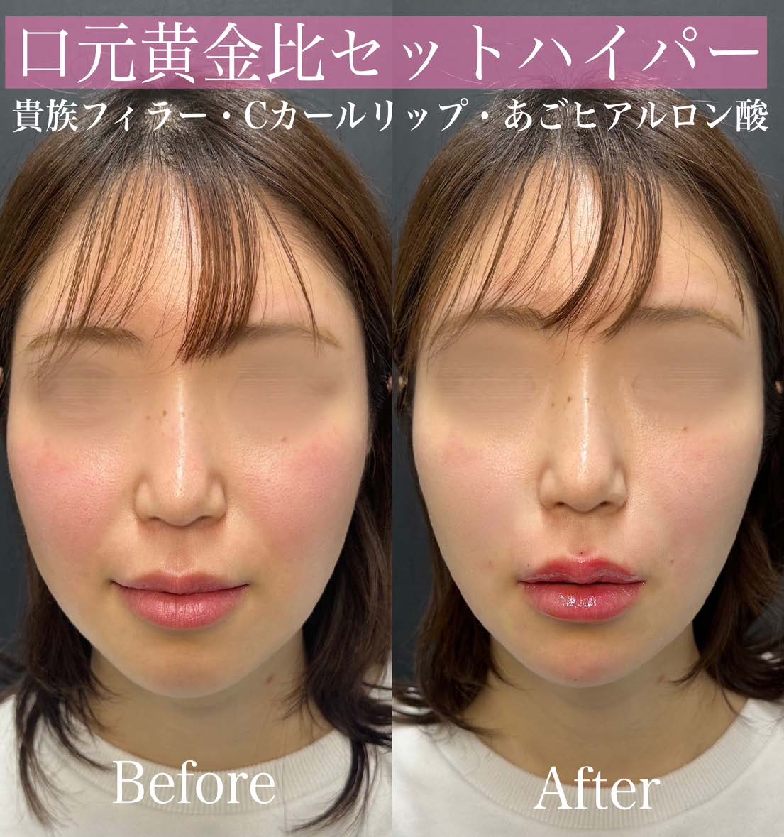 ヒアルロン酸の症例写真