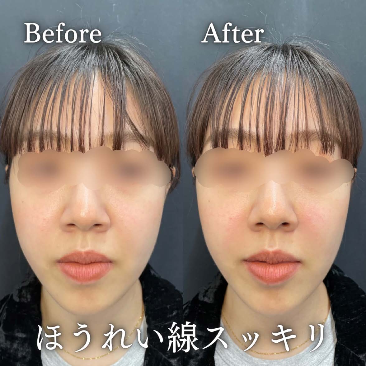 ヒアルロン酸の症例写真