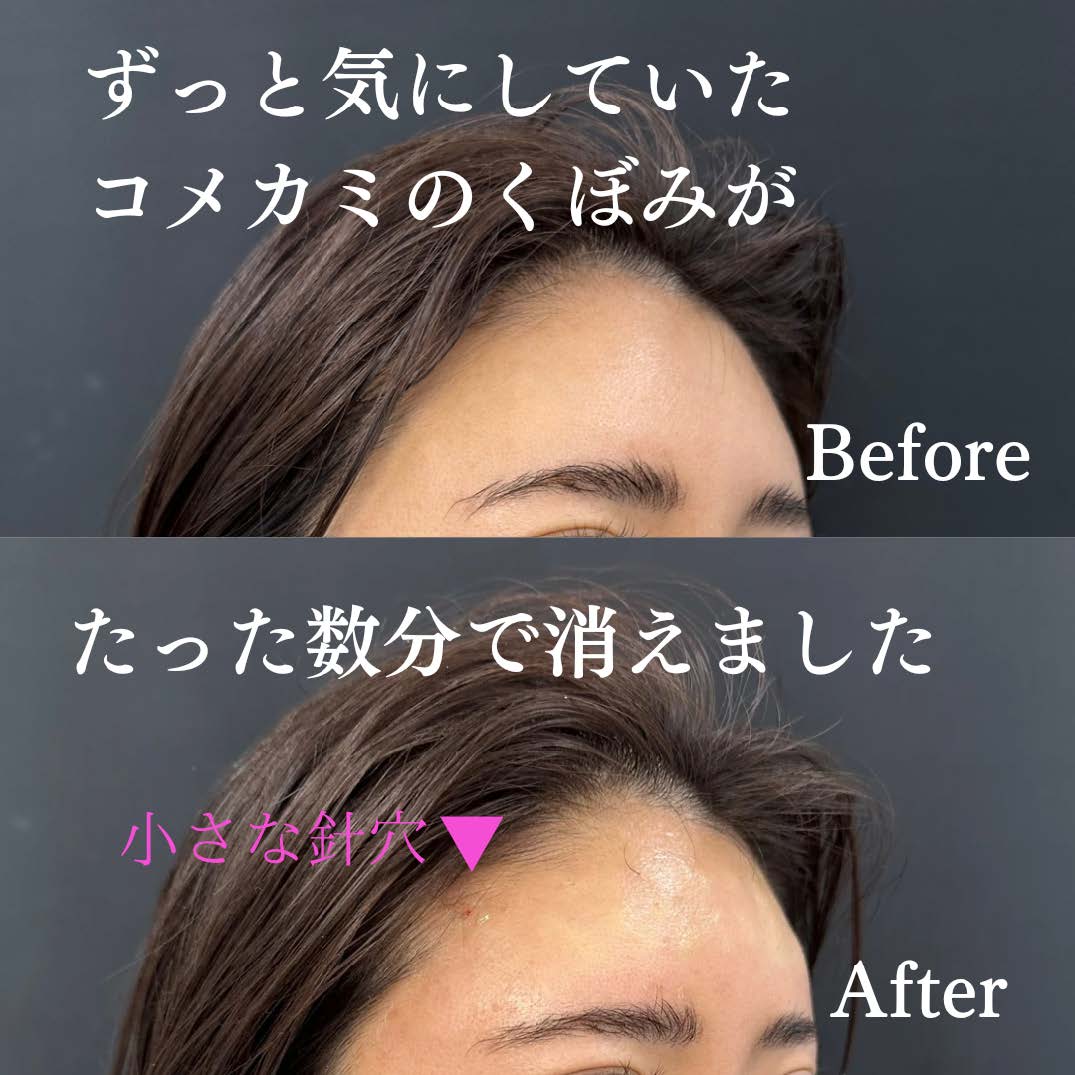 ヒアルロン酸の症例写真