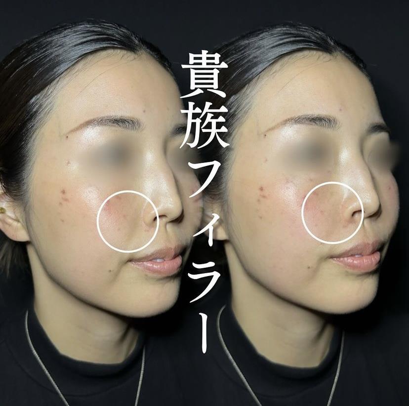 ヒアルロン酸の症例写真