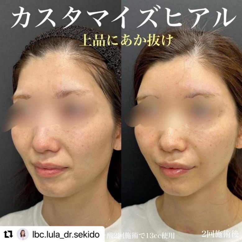 ヒアルロン酸の症例写真