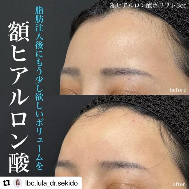 ヒアルロン酸の症例写真