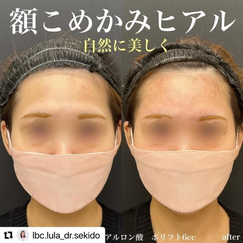 ヒアルロン酸の症例写真