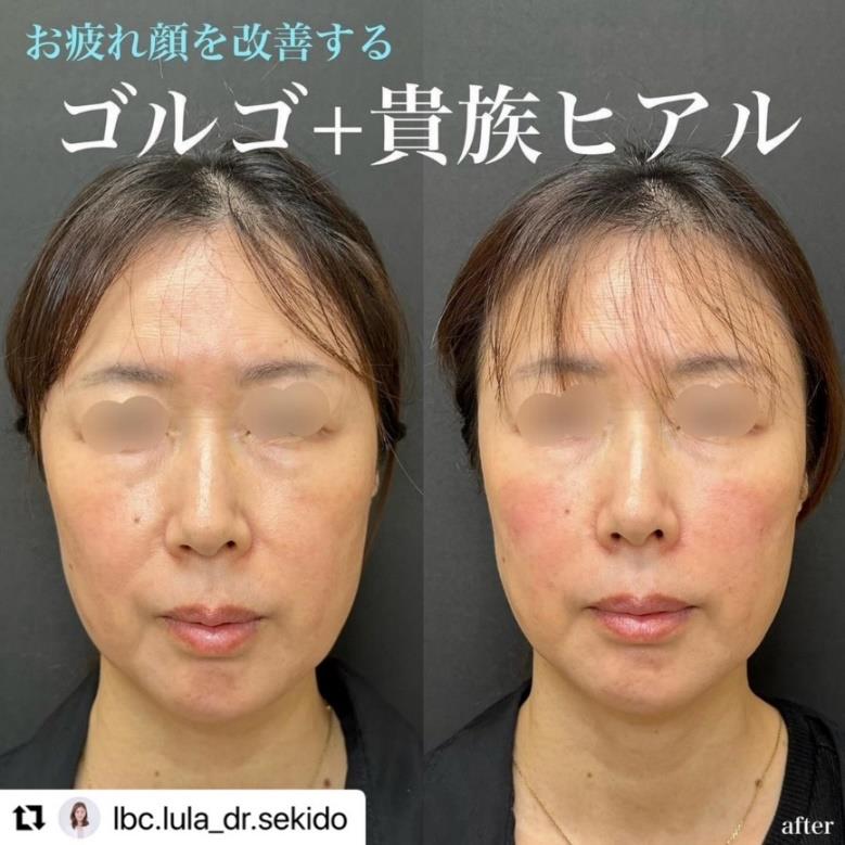 ヒアルロン酸の症例写真