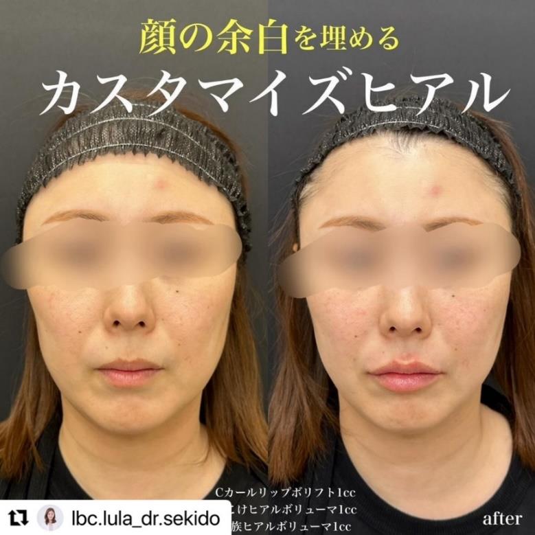 ヒアルロン酸の症例写真