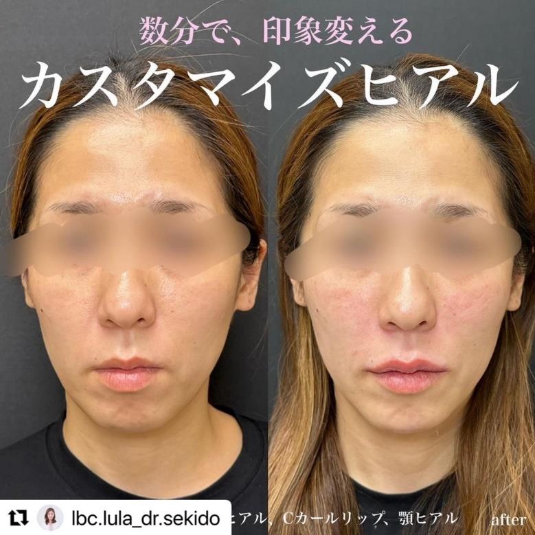ヒアルロン酸の症例写真