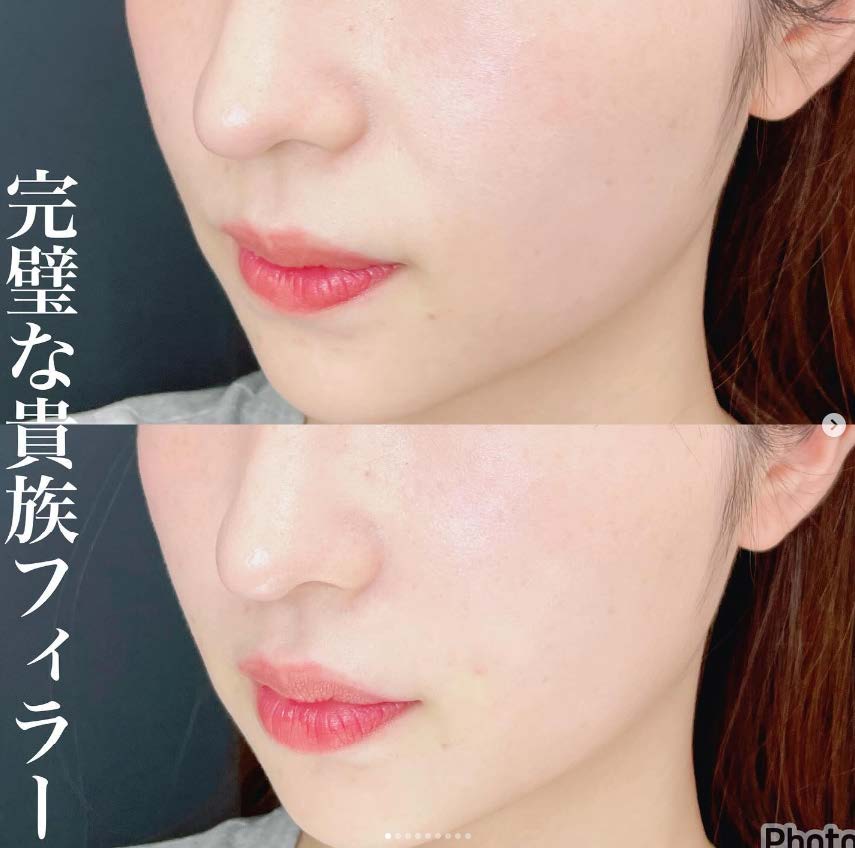 ヒアルロン酸の症例写真