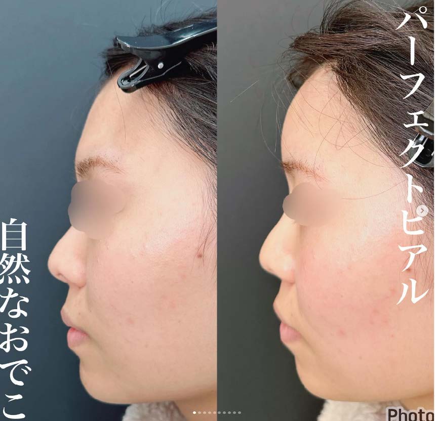 ヒアルロン酸の症例写真