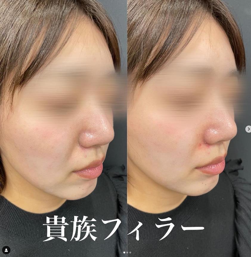 貴族フィラーの症例写真