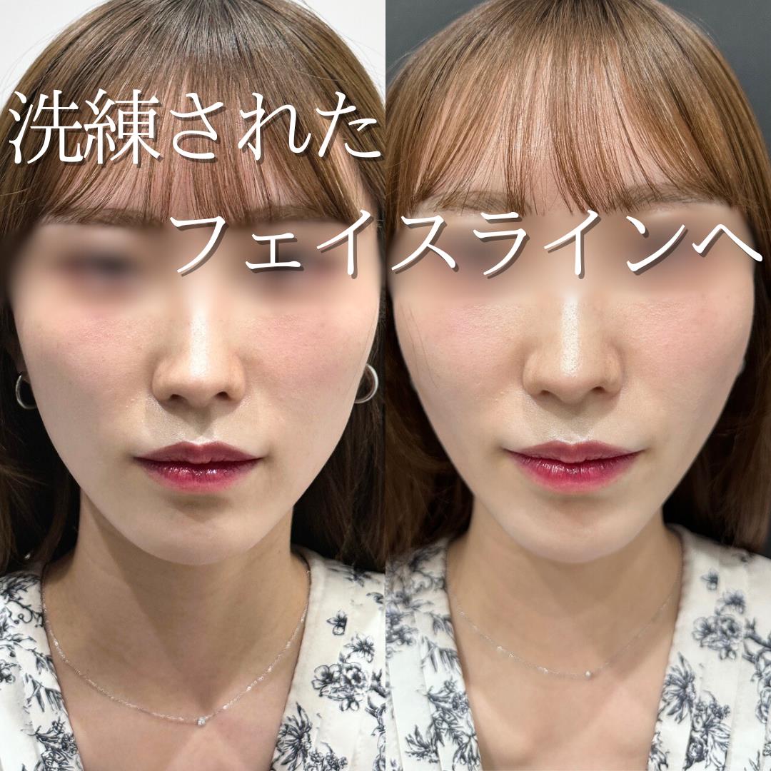 貴族フィラーの症例写真