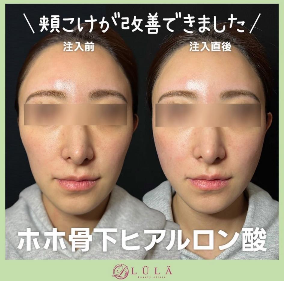 貴族フィラーの症例写真