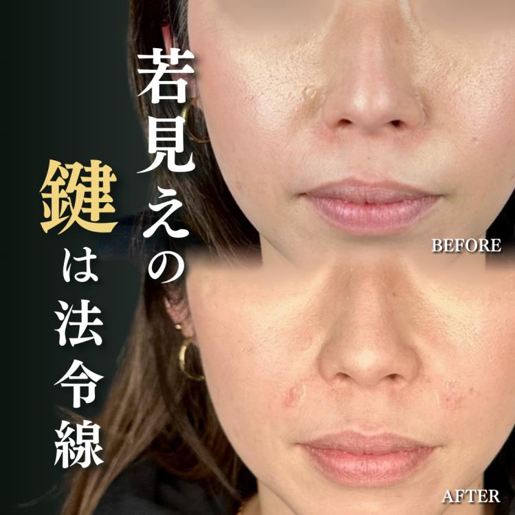 貴族フィラーの症例写真