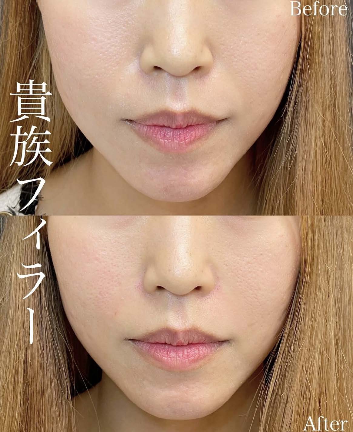 貴族フィラーの症例写真
