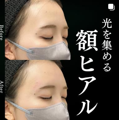 貴族フィラーの症例写真