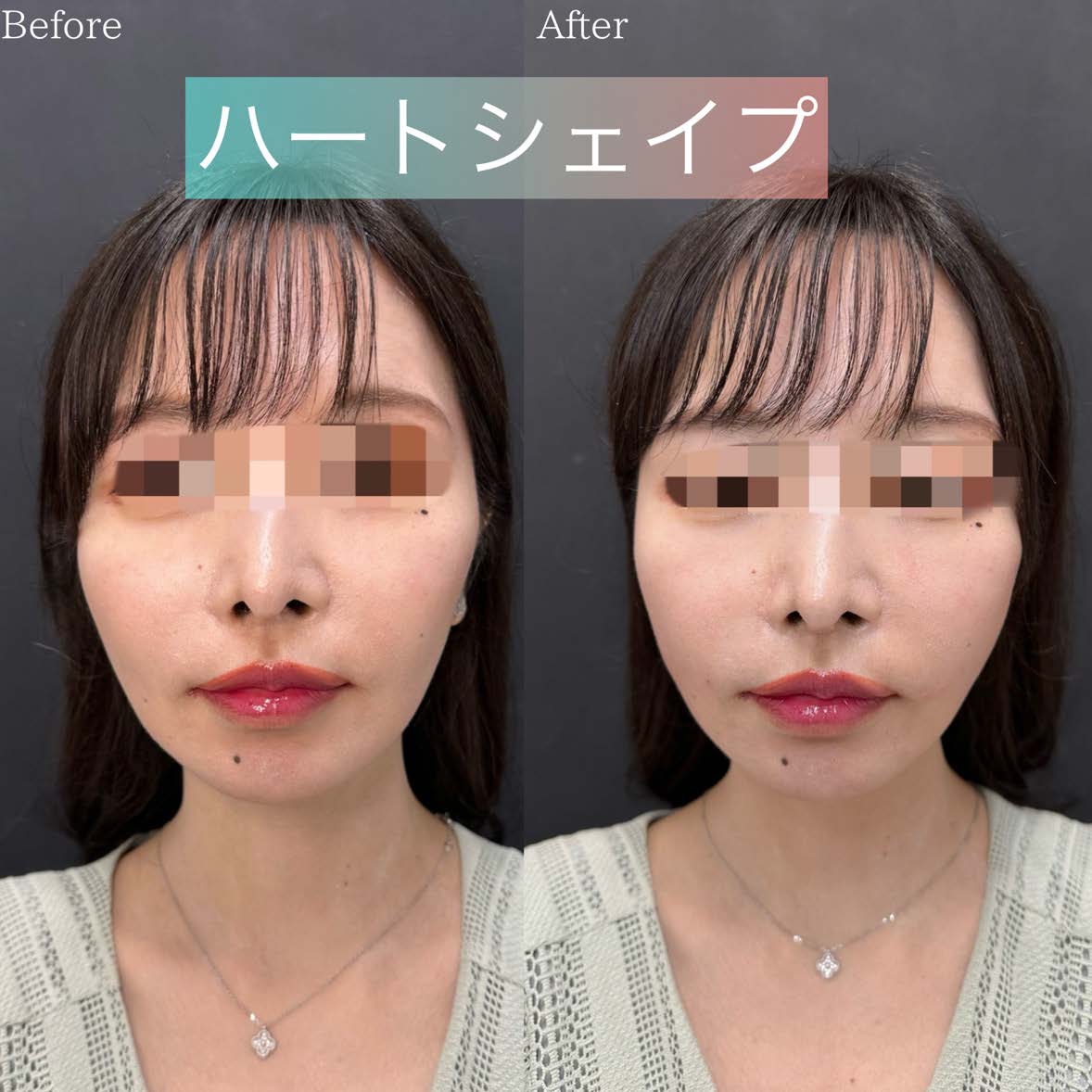 貴族フィラーの症例写真