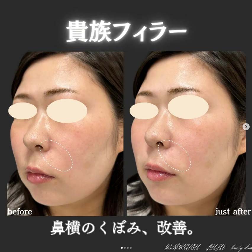 貴族フィラーの症例写真