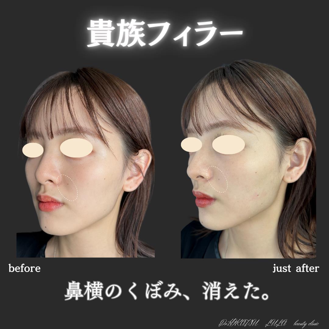 ヒアルロン酸の症例写真