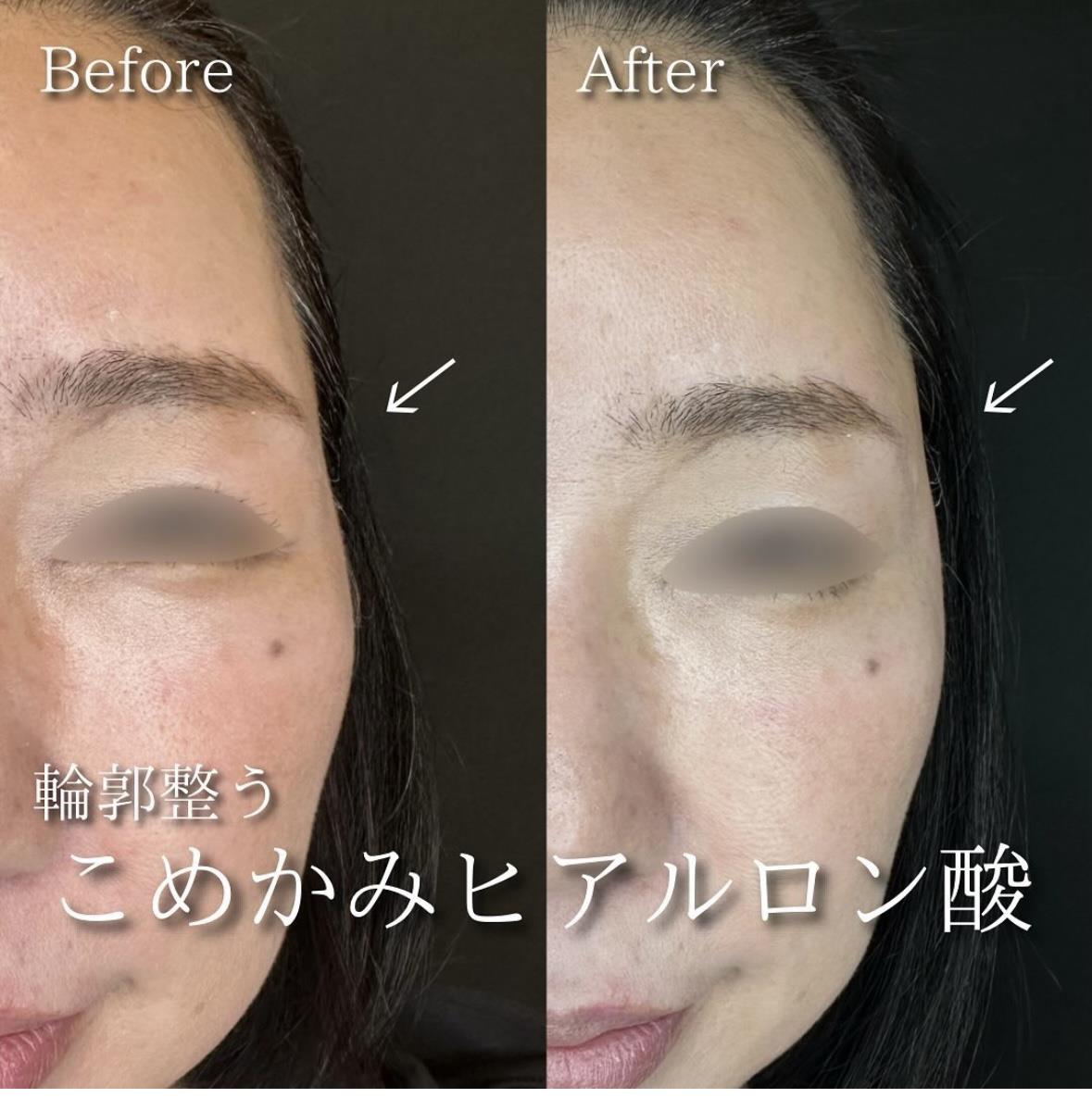 ヒアルロン酸の症例写真