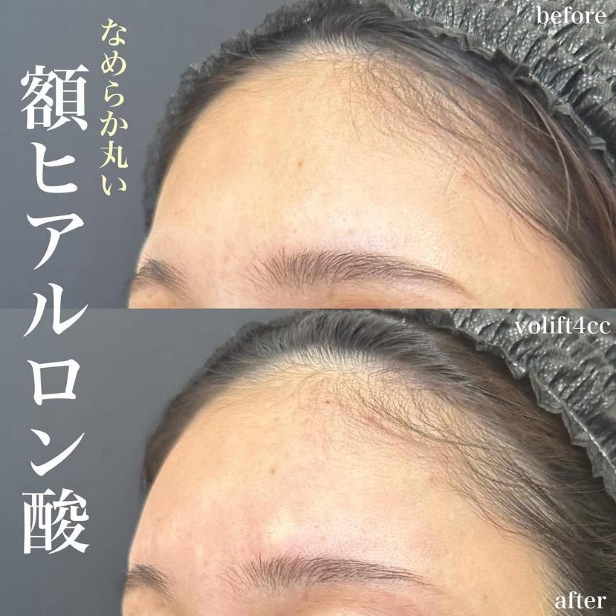 ヒアルロン酸の症例写真