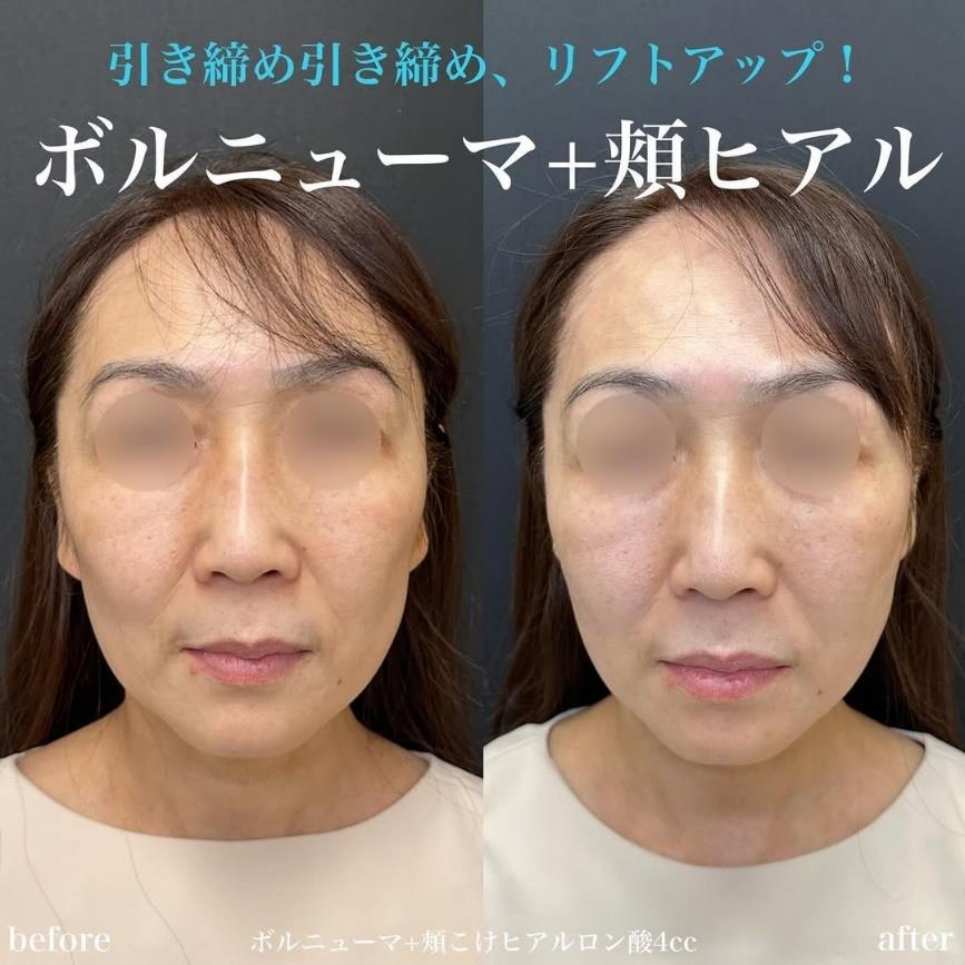 ヒアルロン酸の症例写真