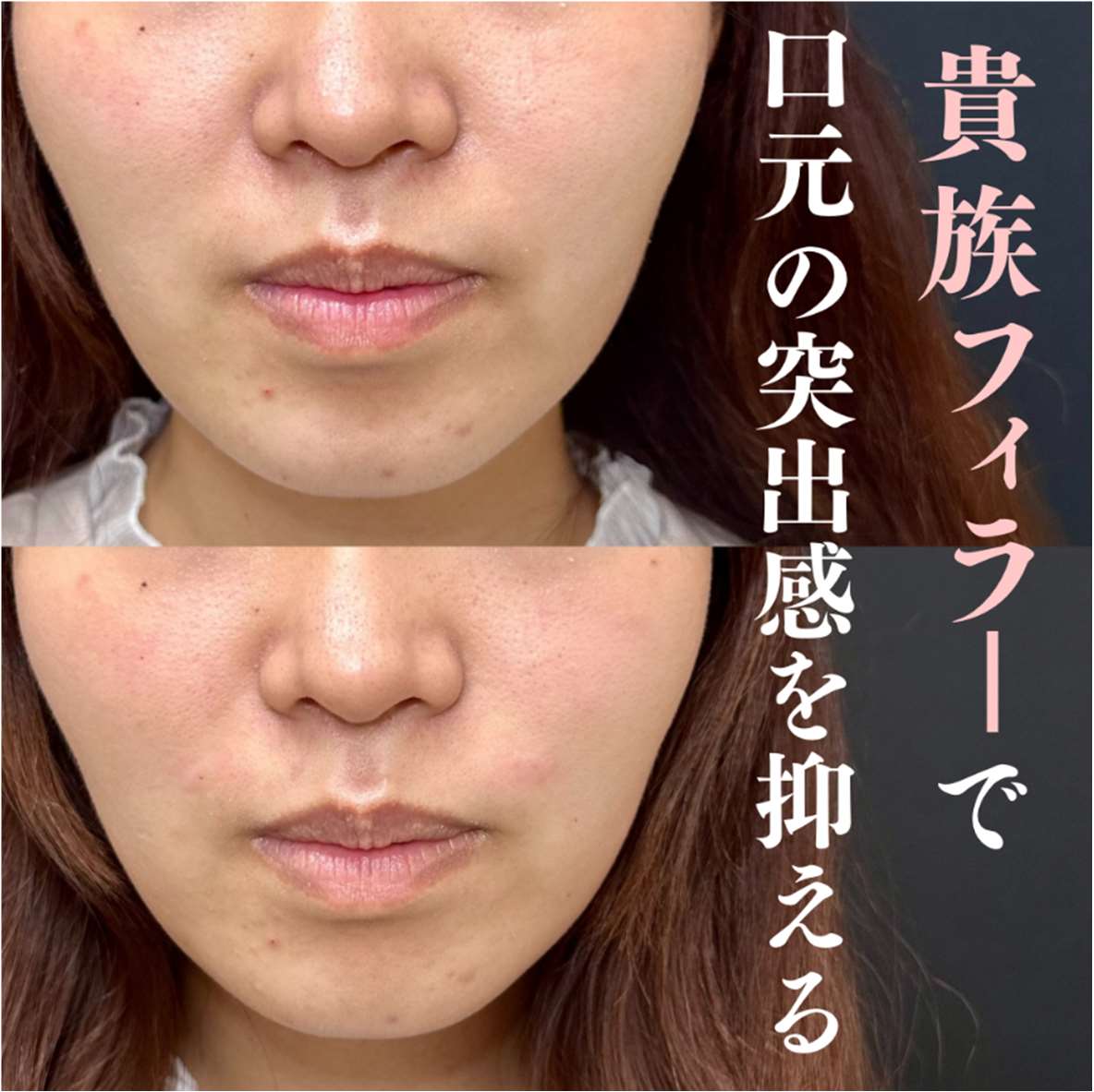 ヒアルロン酸の症例写真