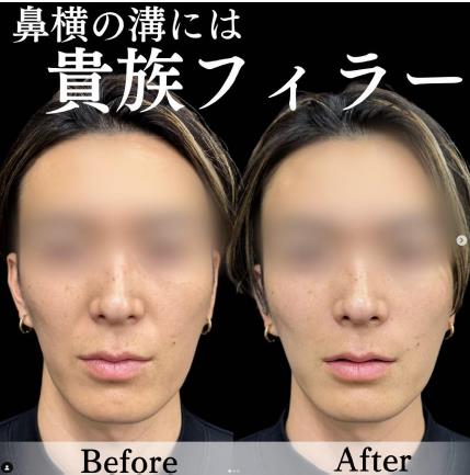 ヒアルロン酸の症例写真