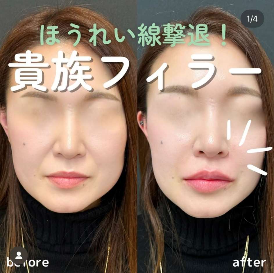 ヒアルロン酸の症例写真