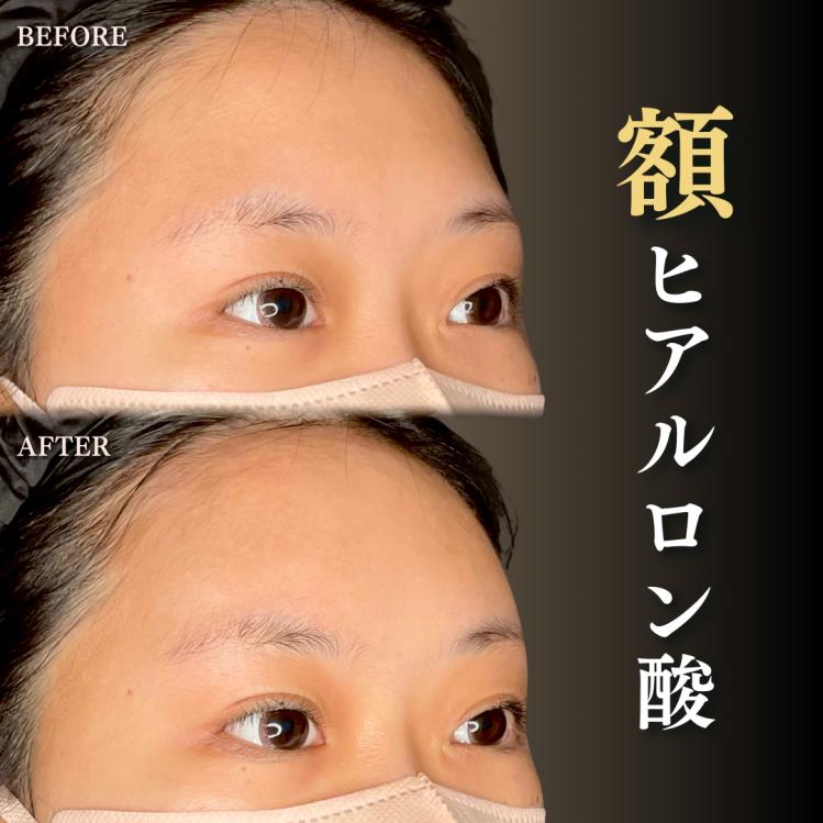 ヒアルロン酸の症例写真