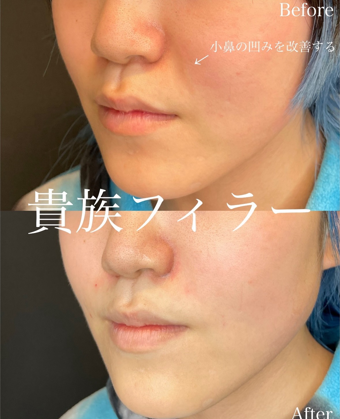 ヒアルロン酸の症例写真