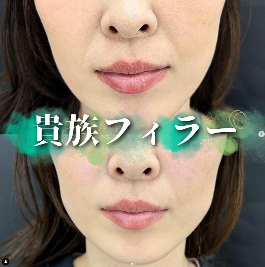 ヒアルロン酸の症例写真