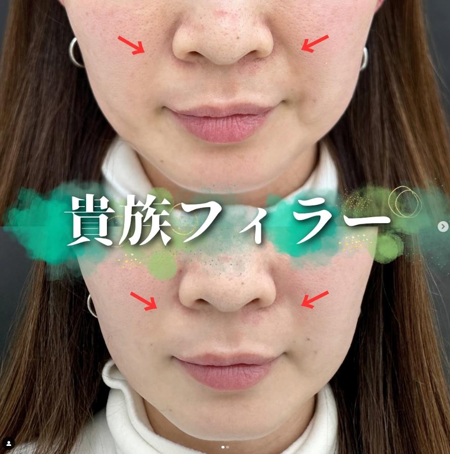 ヒアルロン酸の症例写真