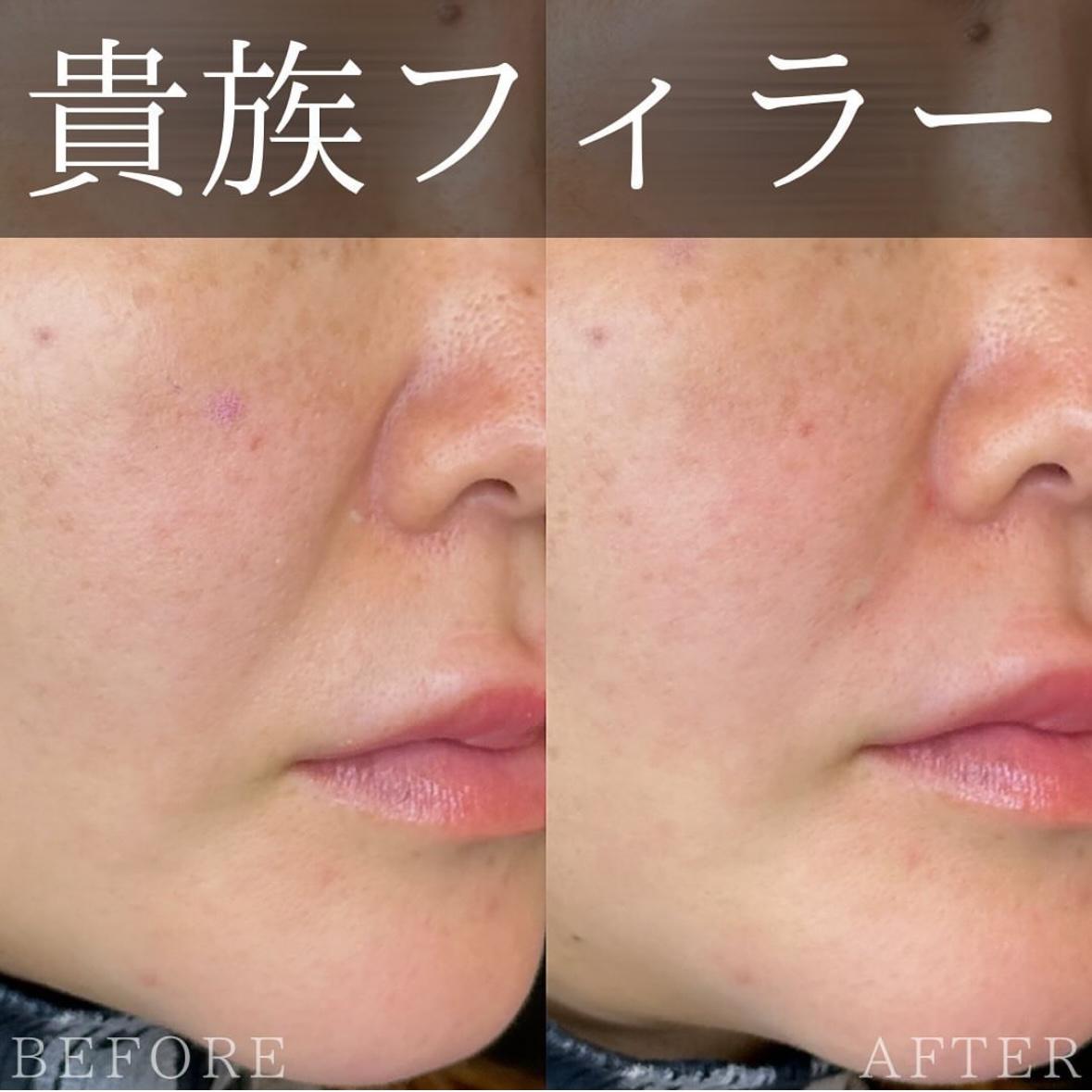 ヒアルロン酸の症例写真