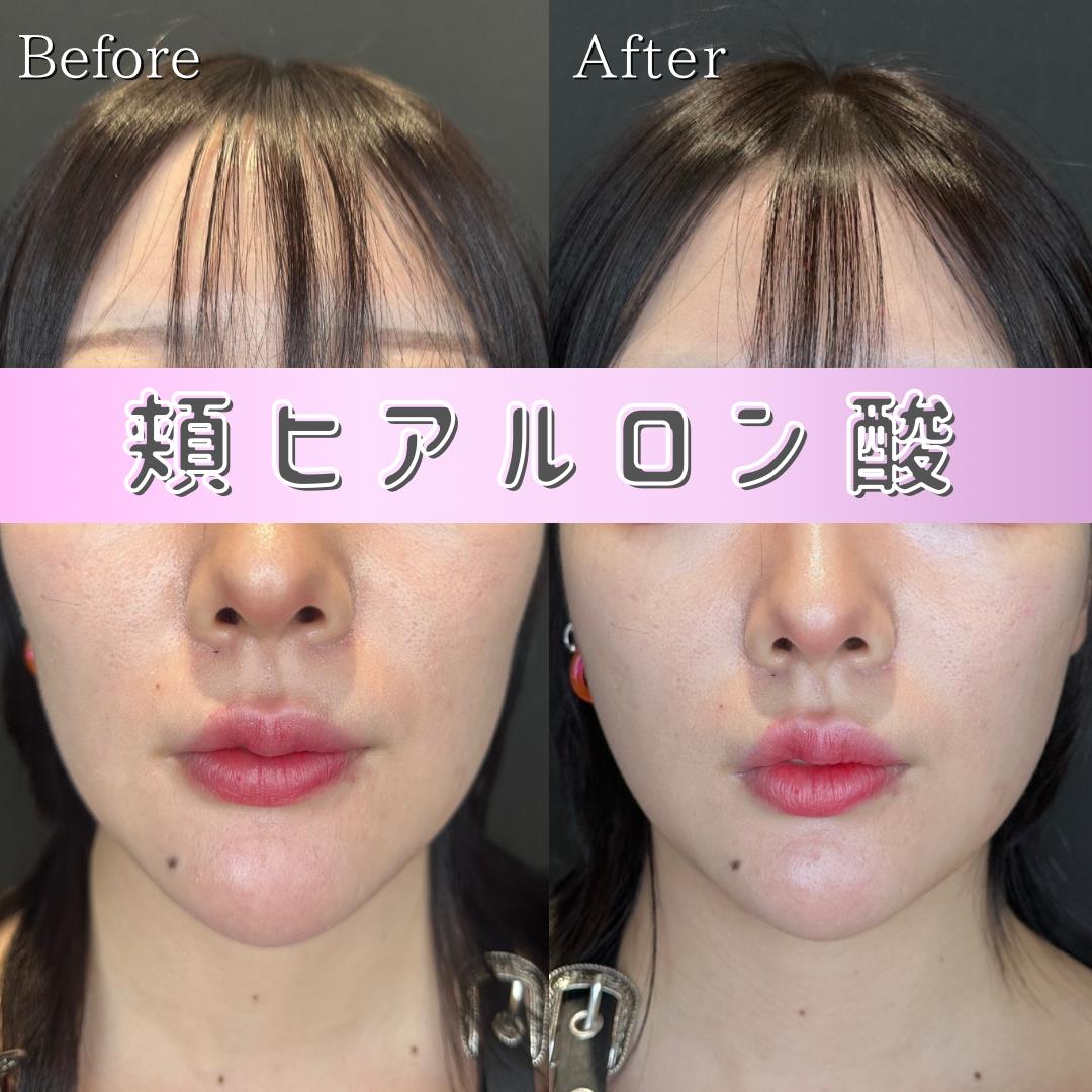 ヒアルロン酸の症例写真