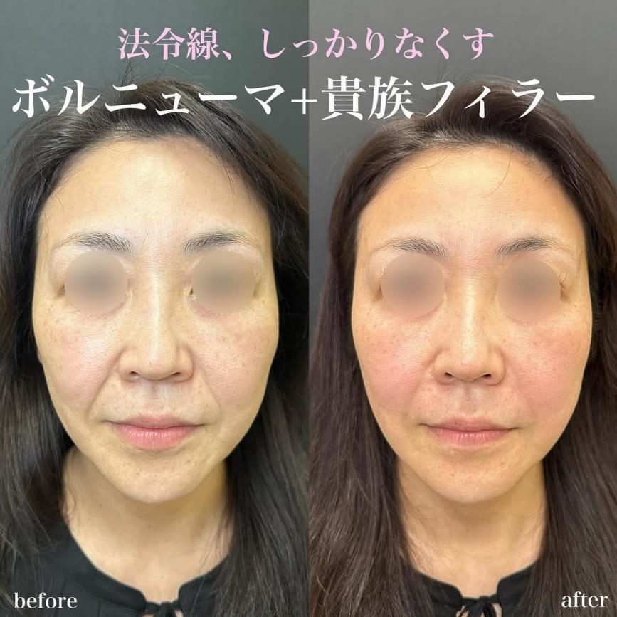 ヒアルロン酸の症例写真