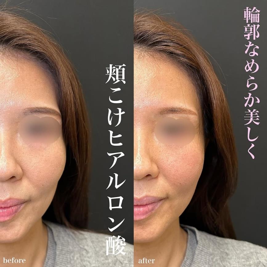 ヒアルロン酸の症例写真