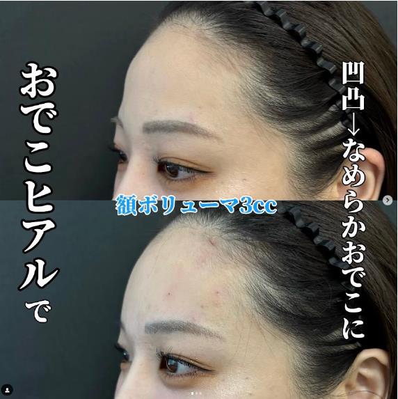 ヒアルロン酸の症例写真