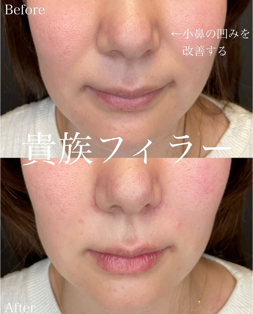 ヒアルロン酸の症例写真