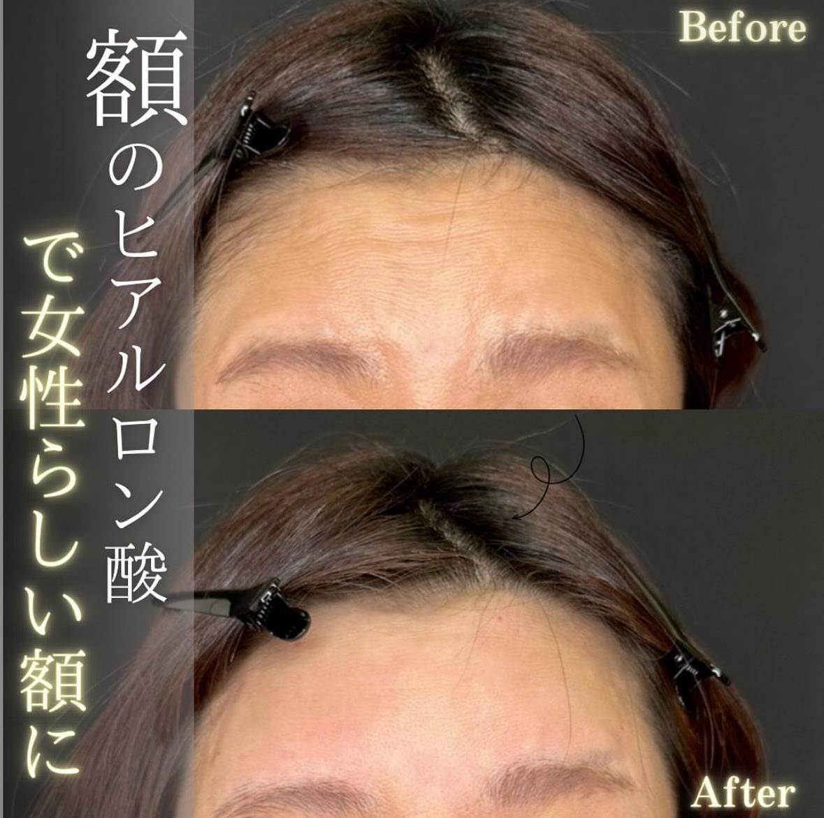 ヒアルロン酸の症例写真