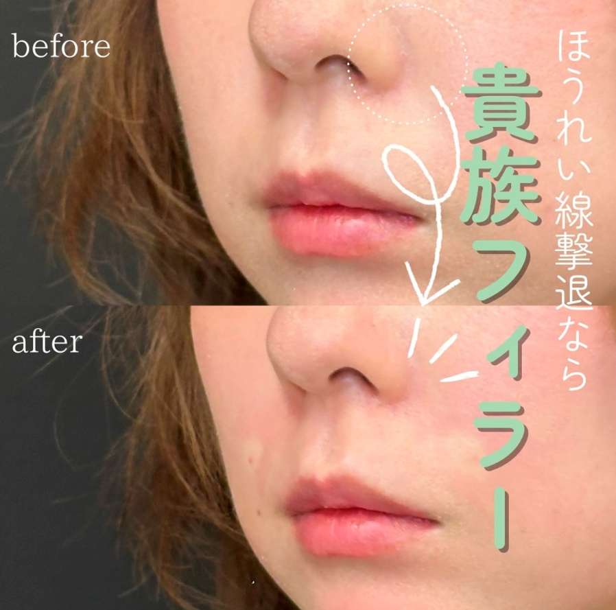 ヒアルロン酸の症例写真